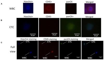 Whole-Exome Sequencing on Circulating Tumor Cells Explores Platinum-Drug Resistance Mutations in Advanced Non-small Cell Lung Cancer